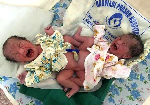 Lindin binjakët e ngjitur në bark, nuk dihet gjinia e tyre