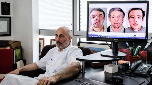 Ky është personi që transplantoi fytyrën tri herë (FOTO)