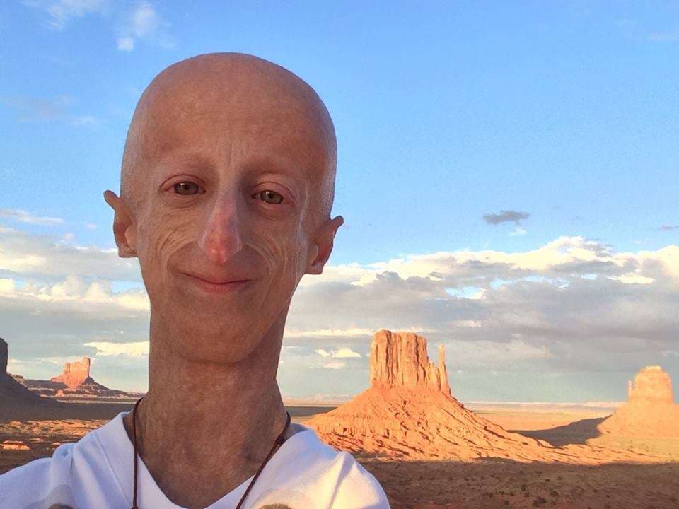 Sammy, 22 vjeçari i cili duket si i moshuar (VIDEO)