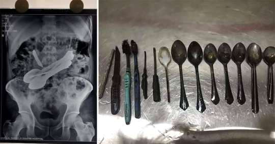 Mjekët heqin tetë lugë dhe një thikë nga zorrët e pacientit (FOTO)