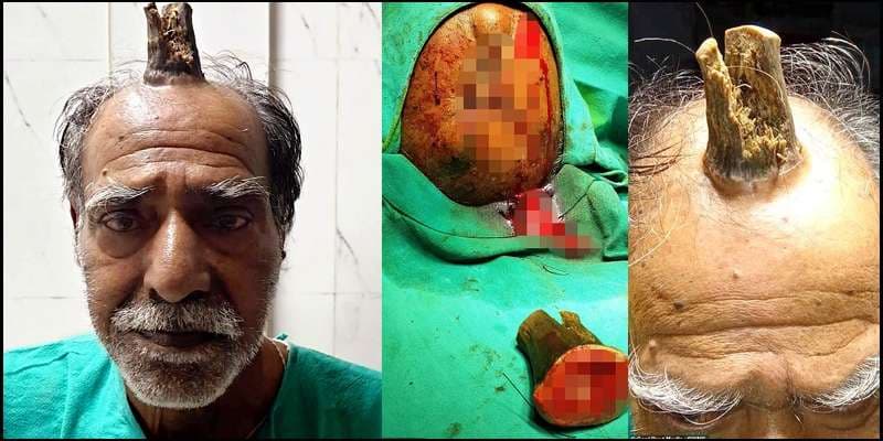 E tmerrshme: Mjekët largojnë “Bririn e djallit” nga maja e kokës së indianit (FOTO)
