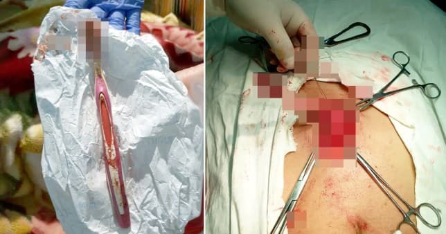 E gëlltiti furçën duke pastruar dhëmbët, mjekët ia heqin nga stomaku