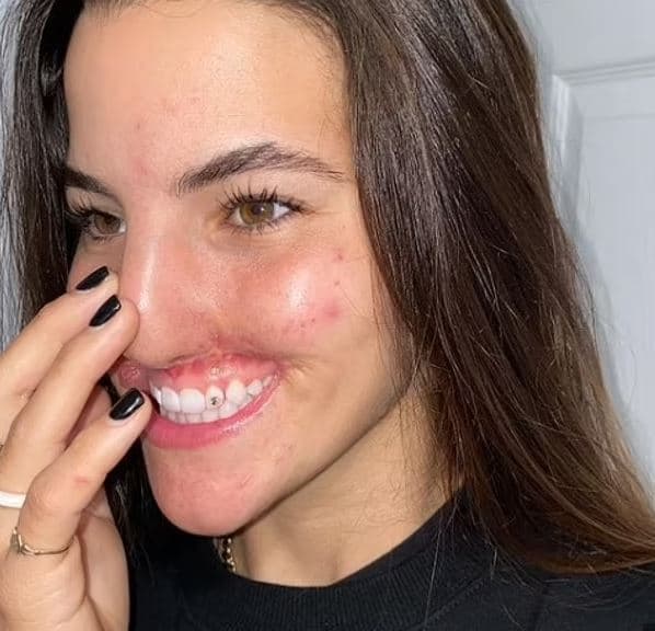 Pitbulli ia shqeu buzën, modelja 22 vjeçare rrëfen sulmin e tmerrshëm