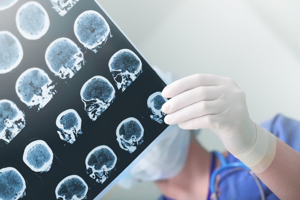 Të mbijetuarit e sulmit në zemër mund të kenë rrezik më të ulët për shfaqjen e sëmundjes së Parkinsonit