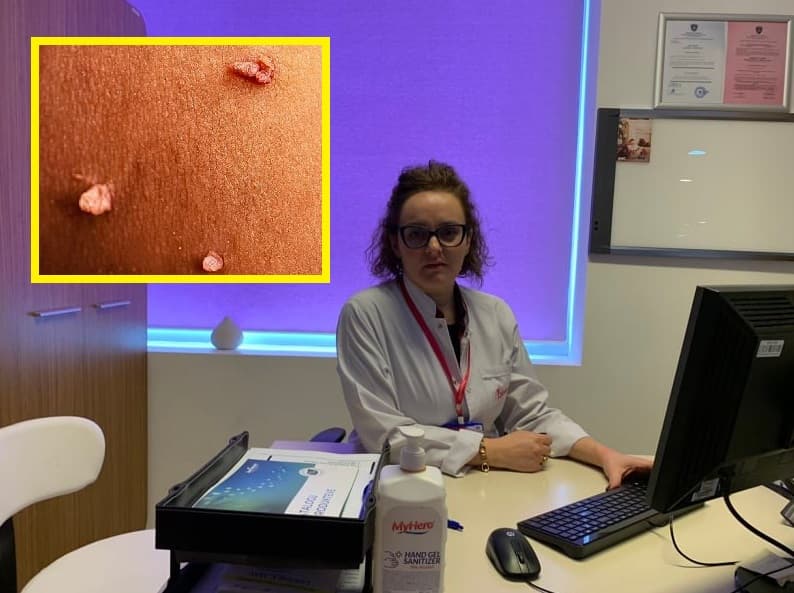 Si mund ta dini nëse e keni HPV-në, virusin kancerogjen e seksualisht të transmetueshëm?