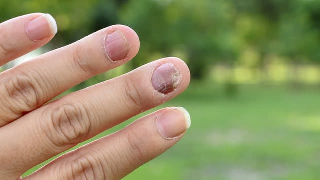 Trajtimet natyrale për këdo që vuan nga myku i thonjve