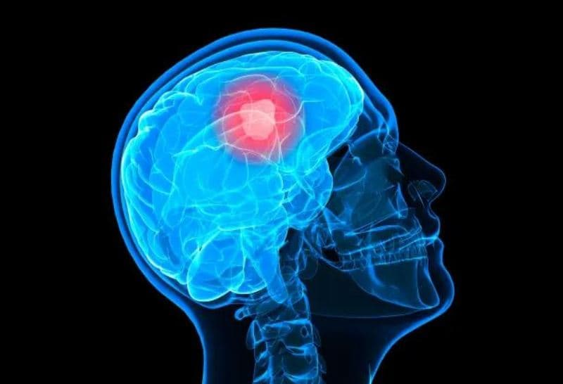 Çfarë është glioblastoma dhe cilat janë simptomat kryesore?