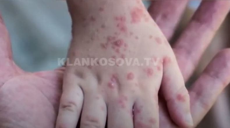 Lija e majmunëve mund të vijë edhe në Kosovë, por pa rrezik (VIDEO)