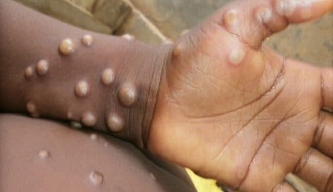 OBSh nuk pret që shpërthimi i lisë së majmunëve të evoluojë në pandemi si COVID-i