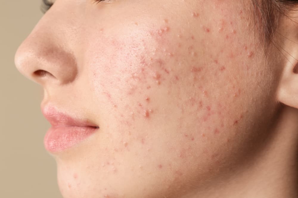 Aknet janë të zakonshme, por jo normale, thonë dermatologët