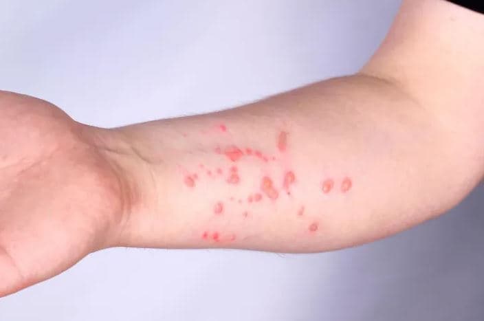 Rast i rrallë: Italiani rezulton pozitiv për COVID, HIV dhe linë e majmunëve pas një udhëtimi në Spanjë