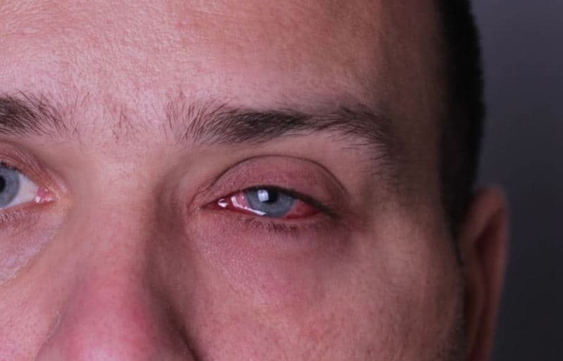 Mjekët zbulojnë se lija e majmunëve mund të shkaktojë infeksion në sy dhe t'i verbojë njerëzit