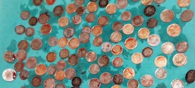 Indi: Burrit i hiqen 187 monedha nga barku (FOTO)