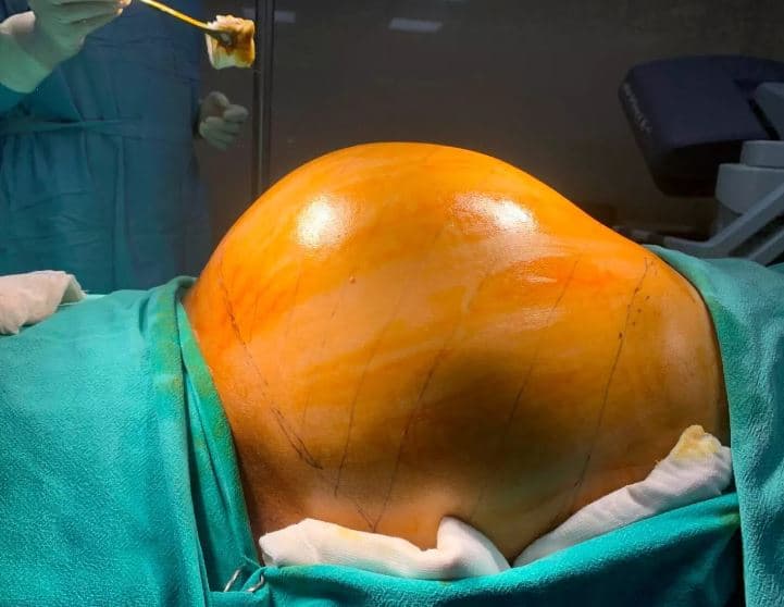 Mjekët i heqin burrit tumorin 10 kilogramësh nga stomaku
