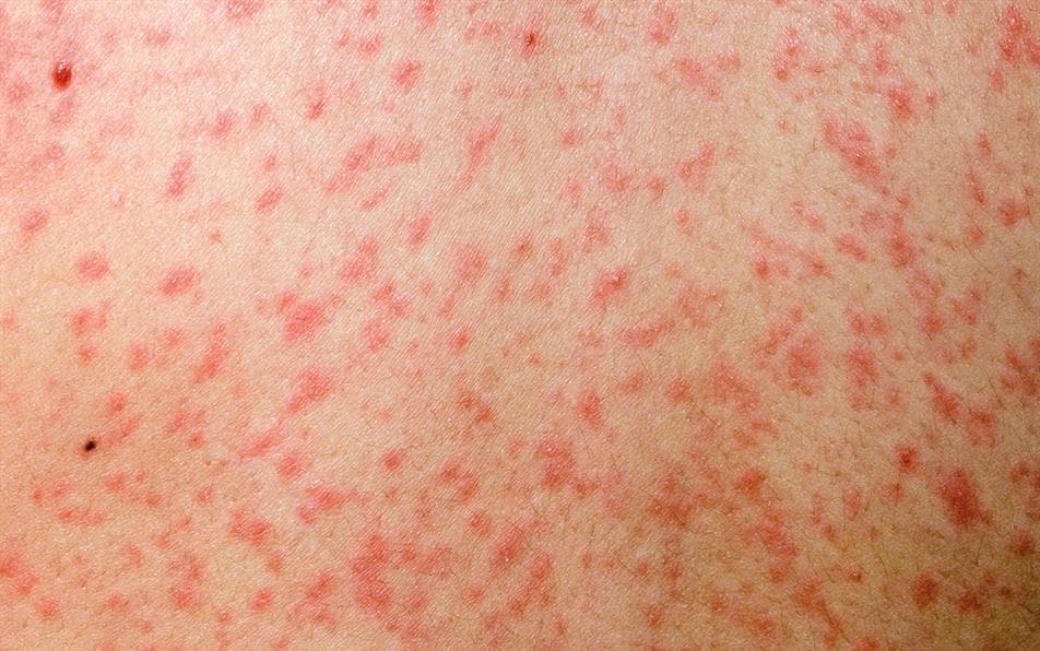 Fruthi: Simptomat, parandalimi dhe këshilla për trajtim