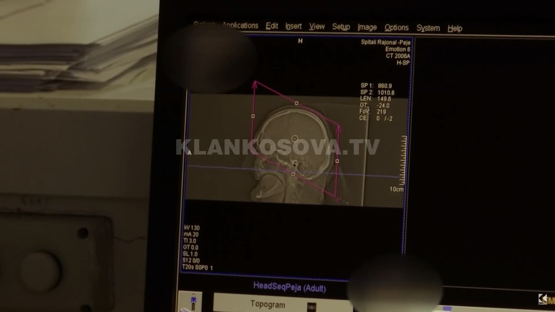 Spitali i Pejës bëhet me Rezonancë Magnetike, por ka veç dy radiologë (VIDEO)
