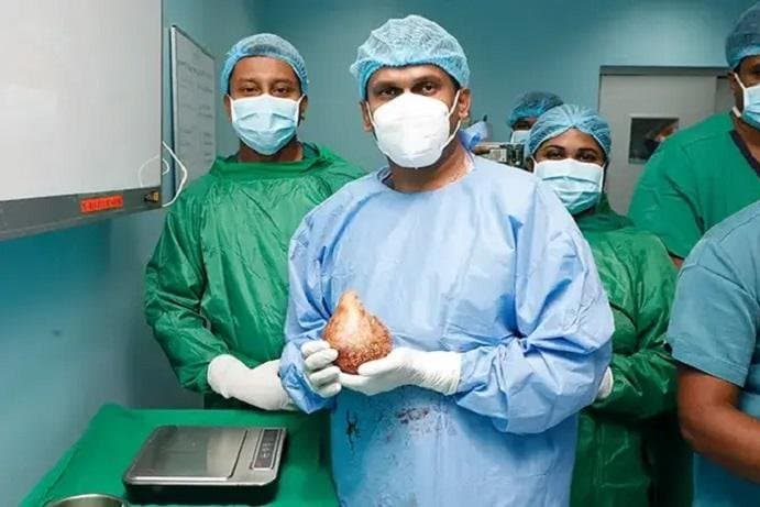 Mjekët e Sri Lankës heqin gurin 13 centimetërsh nga veshka e pacientit