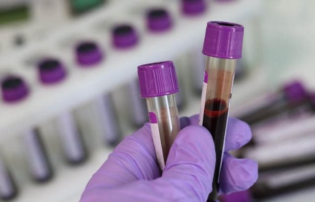Testi i thjeshtë i gjakut mund të ndihmojë në diagnostikimin e çrregullimit bipolar, thonë studiuesit