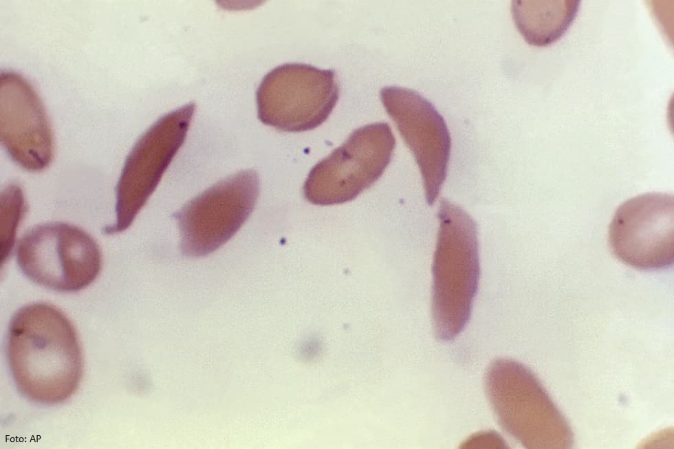Britani: Miratohet terapia e parë gjenetike në botë për sëmundjen e qelizave drapër