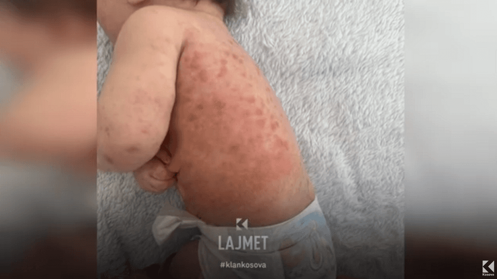Rritet numri i personave të prekur nga zgjeba, 127 raste vetëm në janar (VIDEO)