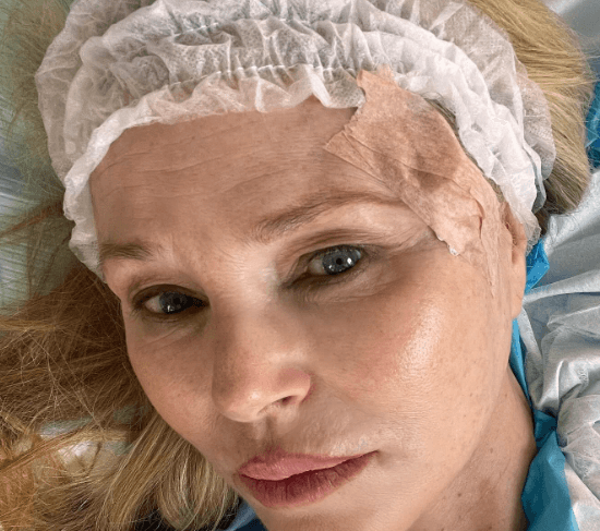 Christie Brinkley iu nënshtrua një operacioni për kancer të lëkurës