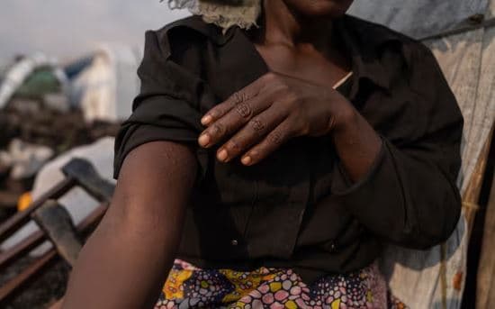Ekzaminimi për Lijën e Majmunëve rritet globalisht, shfaqen raste të tjera jashtë Afrikës