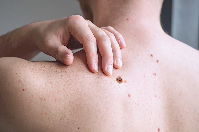 Shenjat e hershme të melanomës: Çfarë duhet të dini?