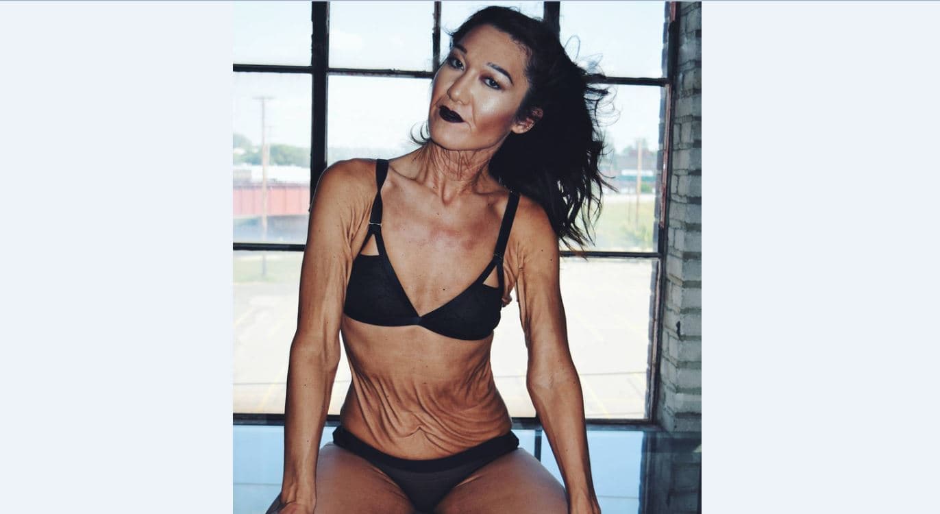 Njihuni me Sara Geurts, modele 31-vjeçare me një çrregullim të rrallë të lëkurës (FOTO)